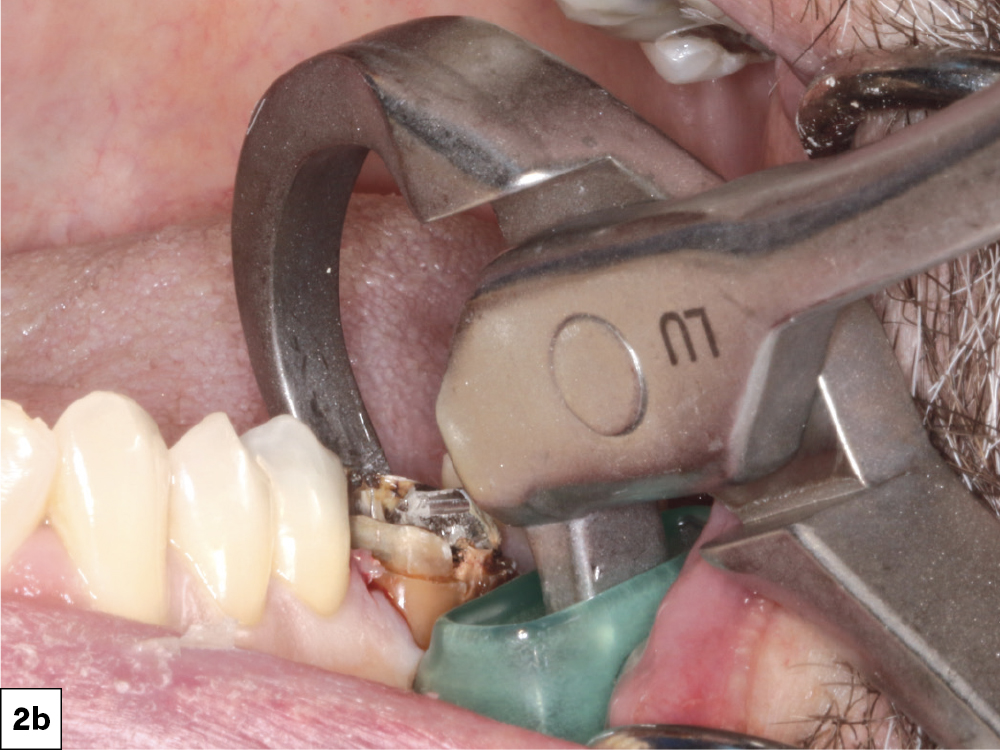 Each root was then removed individually, treating them as separate single-rooted teeth