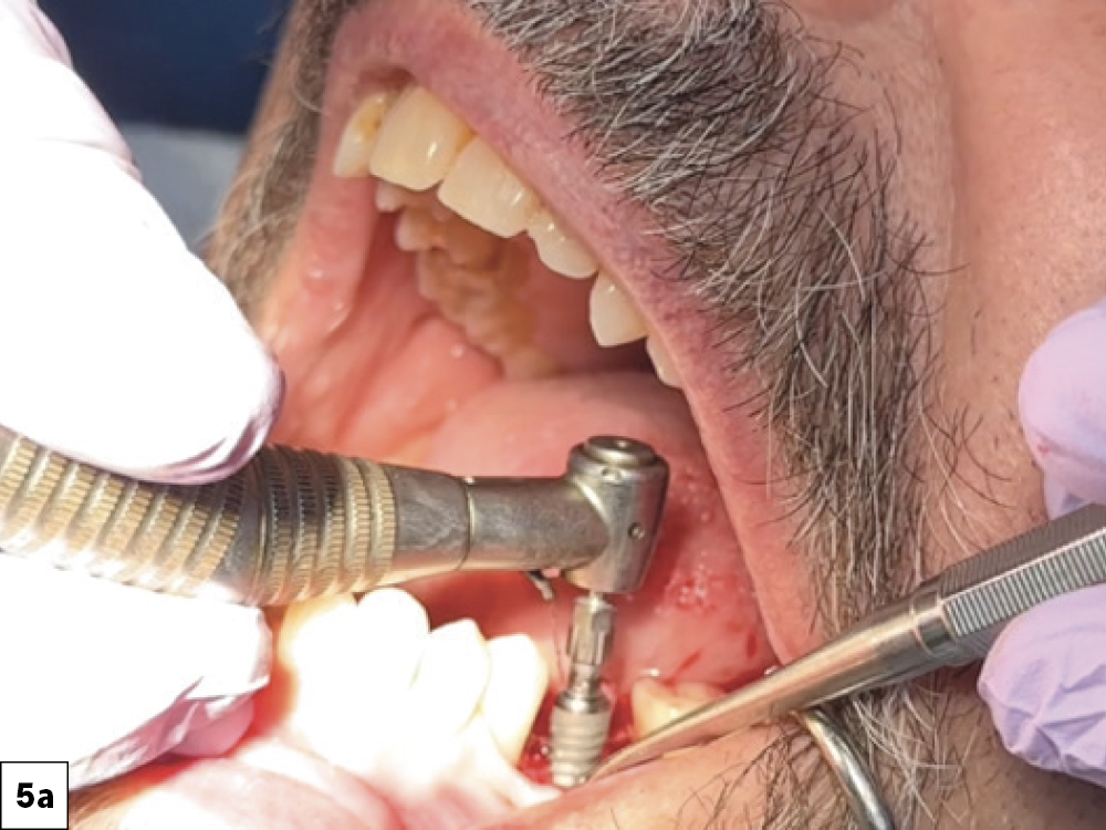 I performed a reflection on the facial of the edentulous space, demonstrating viable bone for implant placement