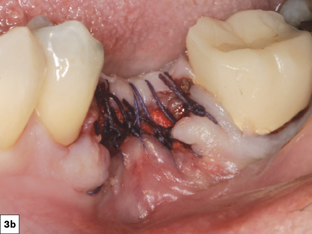 Primary closure was not required as the epithelium will grow over the top of the graft at a rate of 0.5 mm per day.