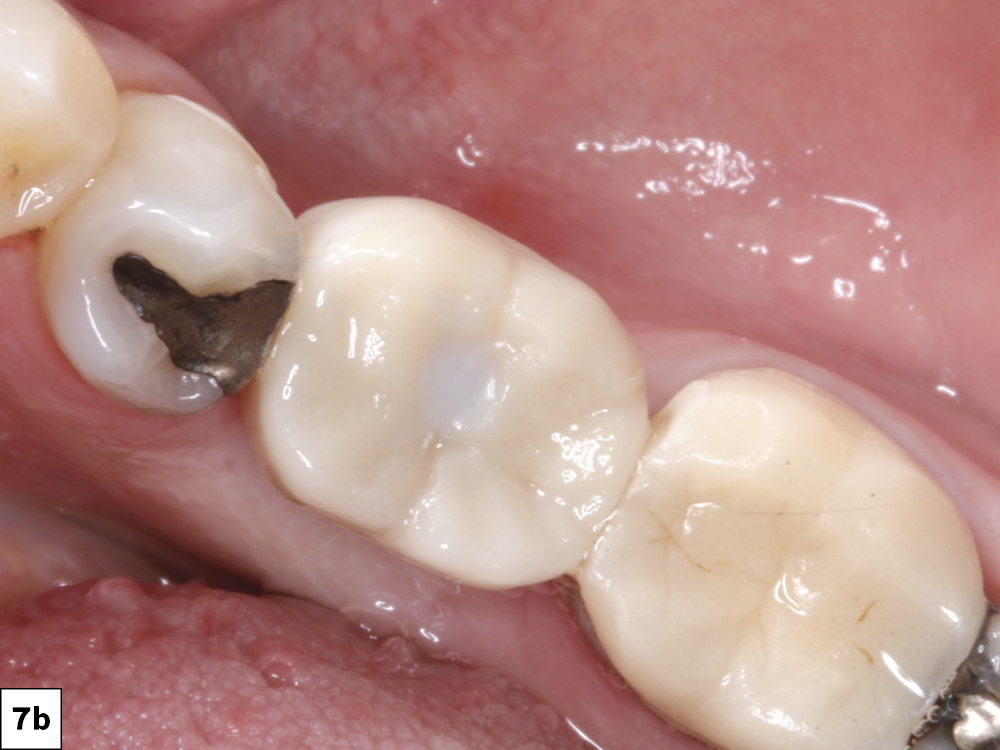 The scan was sent to the lab team at Glidewell, who fabricated a BruxZir® Full-Strength screw-retained crown