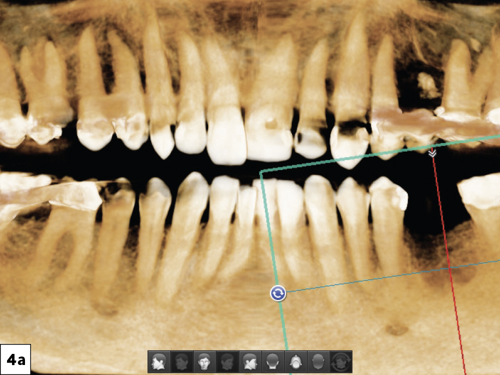 A CBCT analysis was completed, and the sagittal view helped determine that there was adequate bone for implant placement