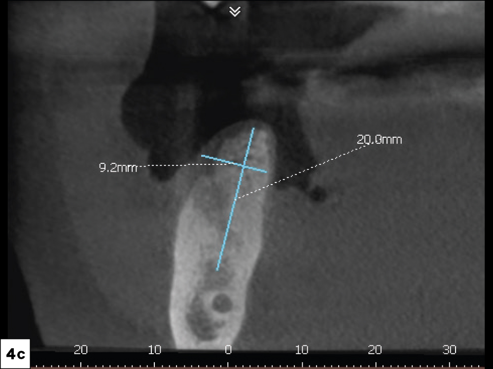 A CBCT analysis was completed, and the sagittal view helped determine that there was adequate bone for implant placement