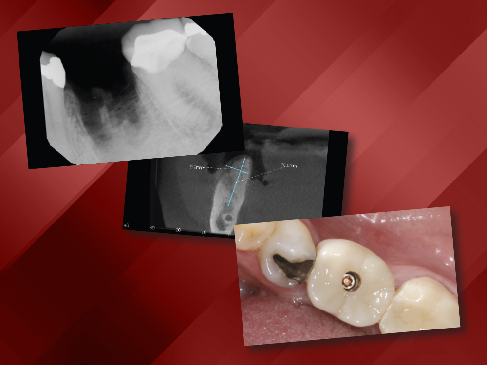 From Extraction to Implant Placement to Screw-Retained Crown