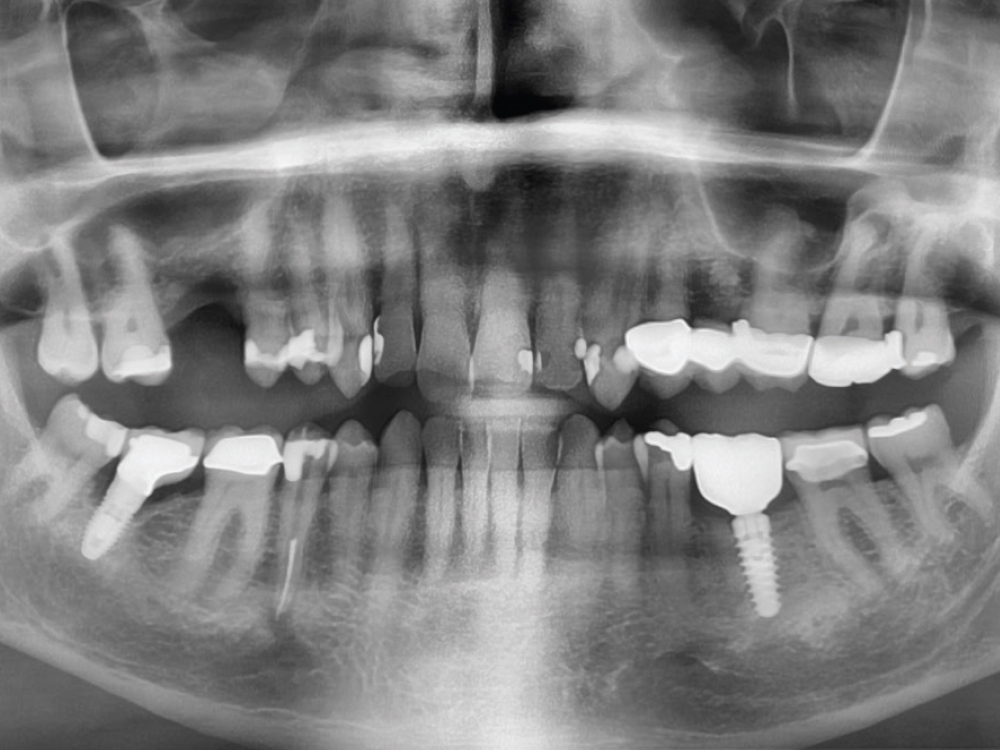 postoperative radiograph confirmed the complete seating of the screw-retained crown into the Glidewell HT implant