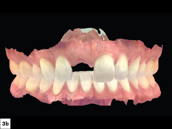 This tissue phenotype offers improved resilience against trauma and recession