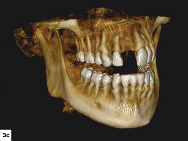 At the initial consultation, comprehensive digital records — including clinical photographs, intraoral scans, and CBCT imaging — were obtained