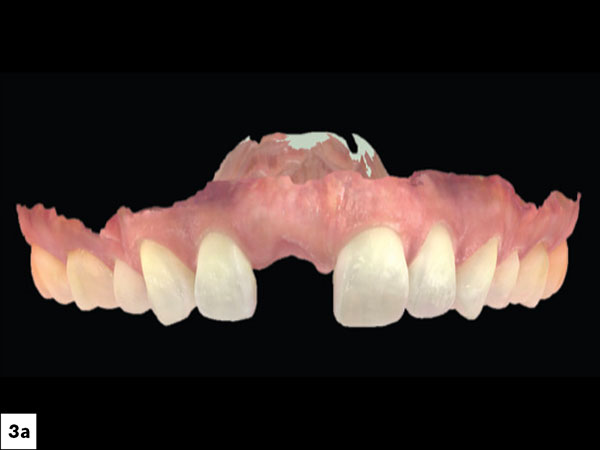 The patient’s previous dentist had extracted #8