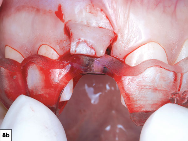 Using the Glidewell HT™ Implant Guided Surgical Kit (Glidewell Direct; Irvine, Calif.), the osteotomy was prepared