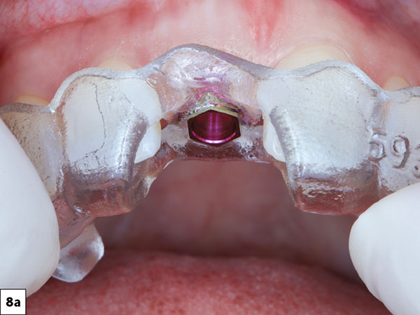 the surgical guide was verified for fit