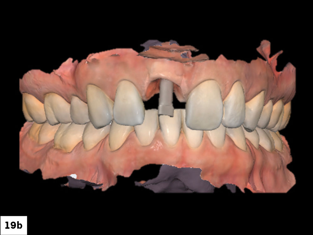 The scan was then completed, capturing both the scan body and peri-implant gingival contours to support accurate restorative design.