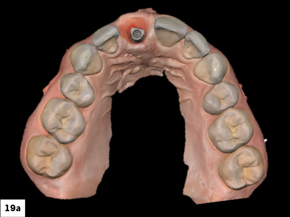 The scan was then completed, capturing both the scan body and peri-implant gingival contours to support accurate restorative design.