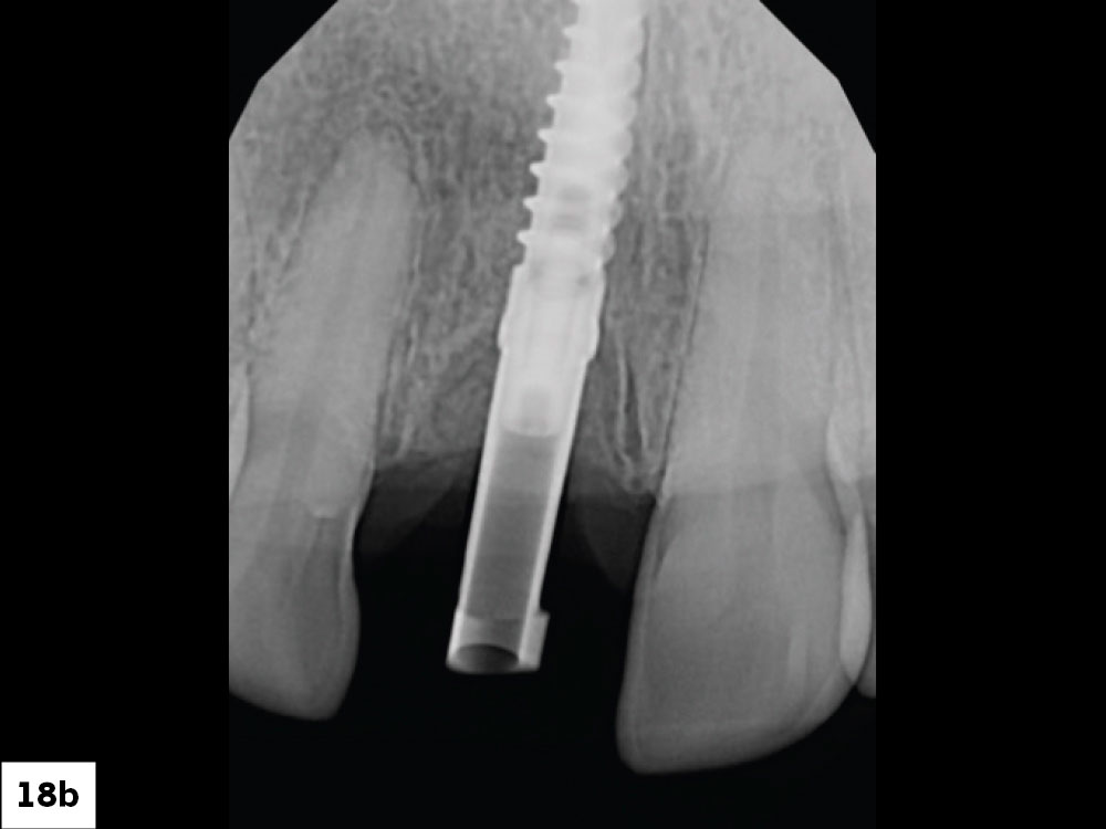 A Glidewell HT™ scan body was placed, and seating was verified with a vertical bitewing