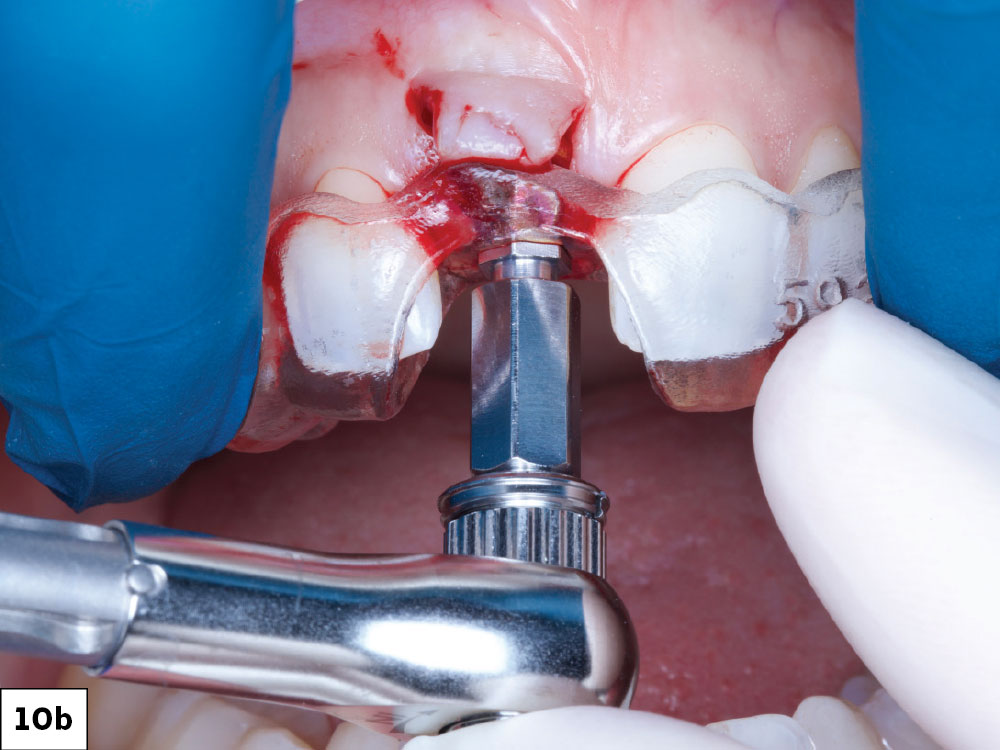 The implant was delivered through the guide, with orientation achieved by aligning the hex of the implant mount to the hex of the guide sleeve.