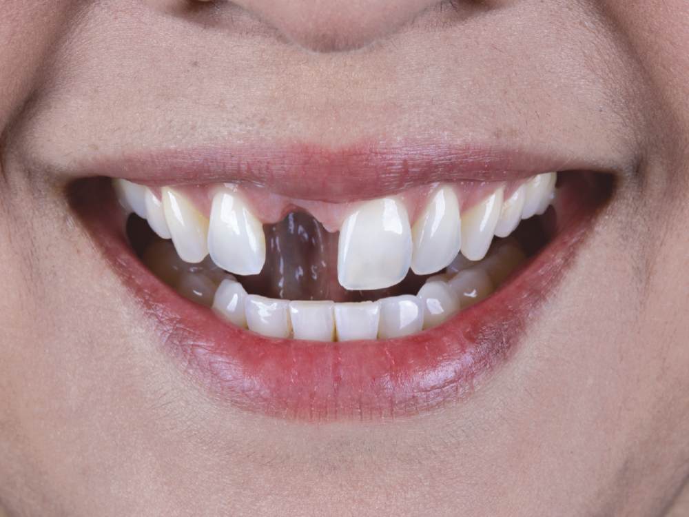 Patients with anterior esthetic concerns often control their smiles to reduce tooth display