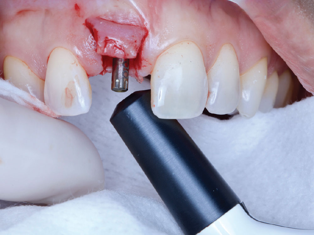 Once torqued into place, the stability of the implant was measured with a Penguin II device