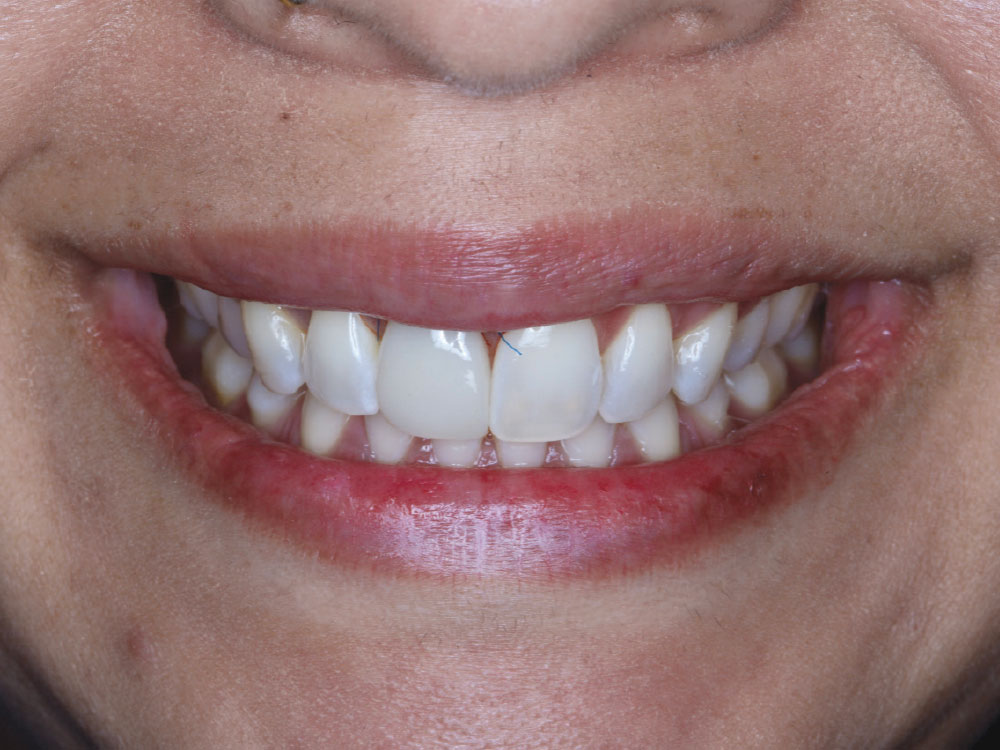 The patient was able to go home with a fixed provisional restoration that was out of occlusion