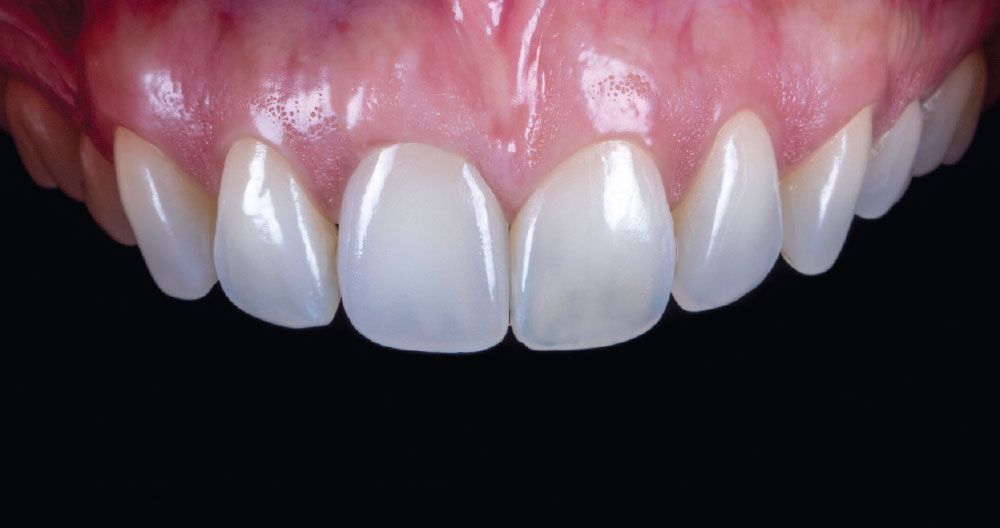 At the delivery appointment, the restoration was tried in to evaluate esthetics