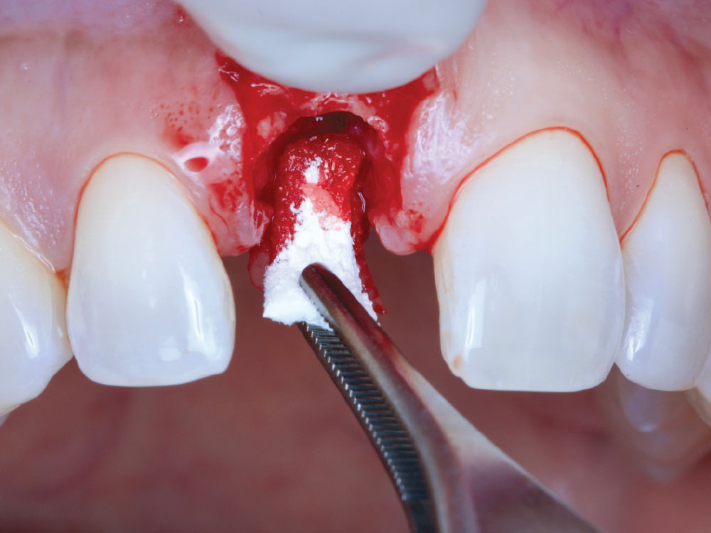 Given the implant positioning required to achieve a screwretained restoration