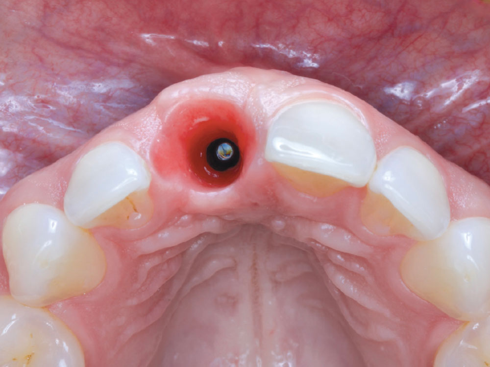 The provisional was removed, revealing well-maintained soft tissue contours with a healthy gingival emergence profile