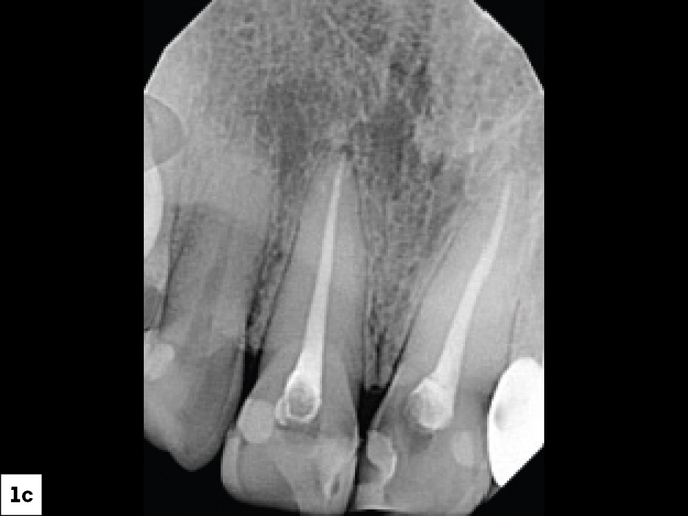 Periapical X-ray of upper anterior teeth showing completed endodontic treatment with posts in the central incisors.
