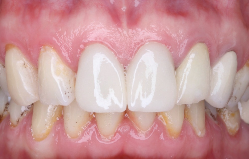Facial intraoral view of cemented BruxZir Esthetic crowns on maxillary central incisors after final delivery.