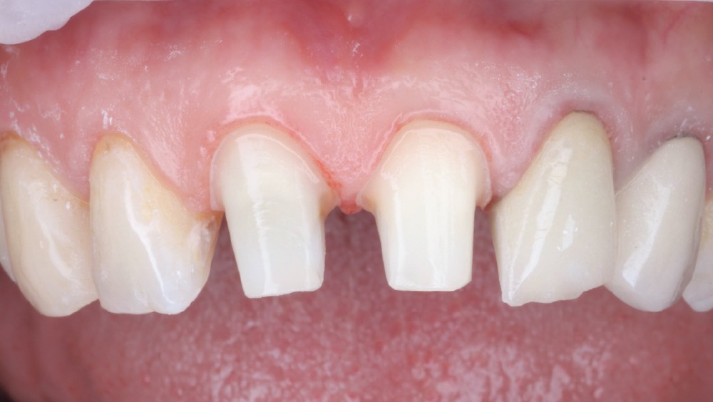 Facial intraoral view of prepared maxillary central incisors with core buildups following removal of temporary restorations.