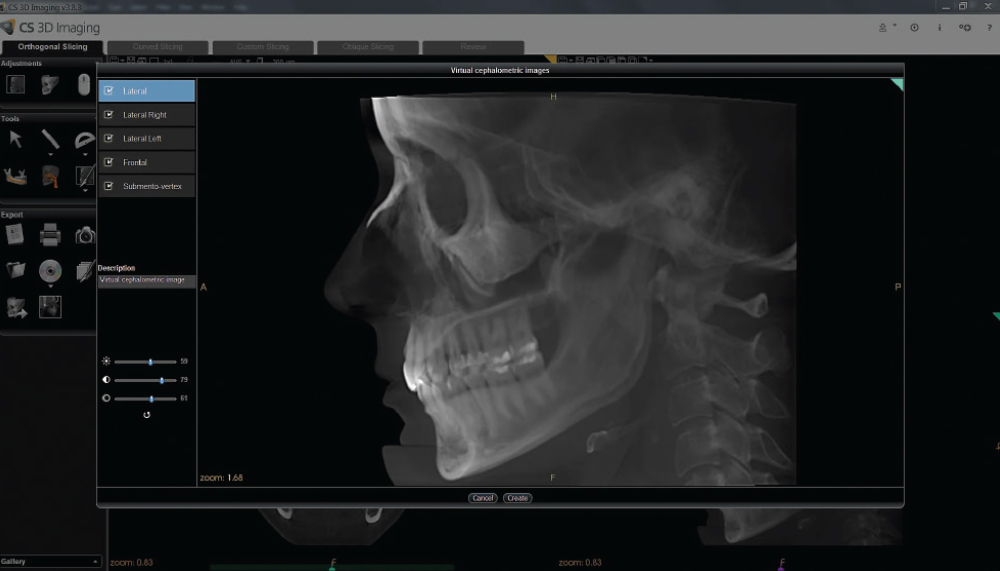 Lateral virtual cephalometric image displayed in CS 3D Imaging software showing skull and jaw anatomy.