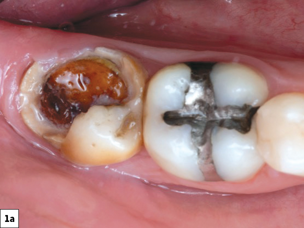 The patient presented with a large carious lesion on tooth #31.
