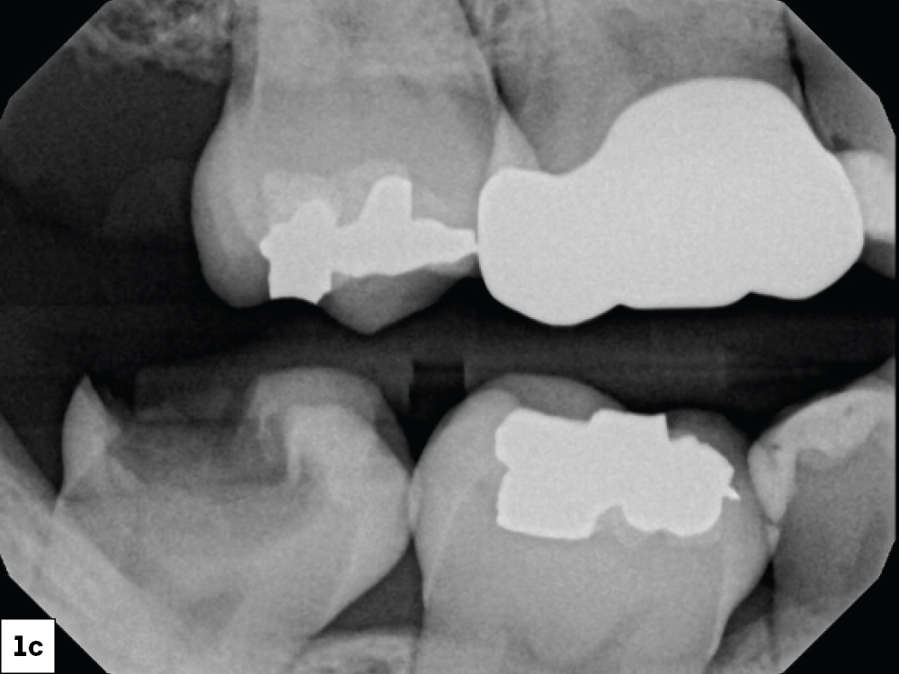 Due to the depth of the lesion and proximity to the pulp, the patient was informed that endodontic therapy and a full-coverage crown may be needed in the future, but at this juncture we could stay with a conservative approach