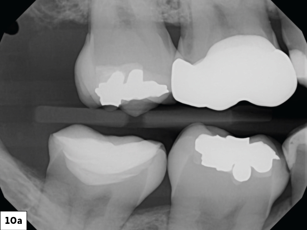 The first cord #00 remained after cementation and had to be removed. This step helped eliminate cement remnants from the sulcus. Finally, I took a bitewing X-ray to ensure no residual cement remained and reviewed the image with the Overjet software.