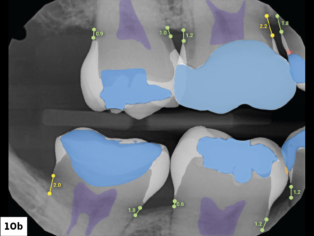 The first cord #00 remained after cementation and had to be removed. This step helped eliminate cement remnants from the sulcus. Finally, I took a bitewing X-ray to ensure no residual cement remained and reviewed the image with the Overjet software.