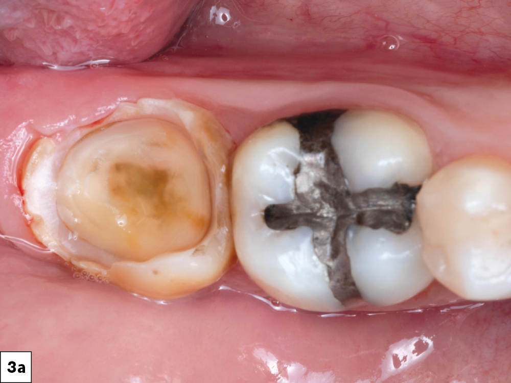 After I removed the decay, the outline of the pulp chamber was clearly visible, indicating a deep lesion, without pulp exposure.