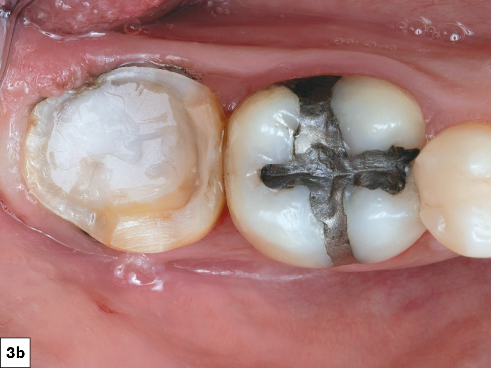 Then I applied Lime-Lite™ cavity liner (Pulpdent Corporation; Watertown, Mass.) to protect the pulp. It is also a great material for bonding.