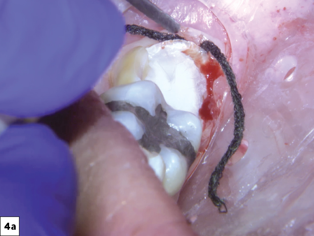 approach every intraoral scan with the understanding that a margin must be clearly identified in order to be restored