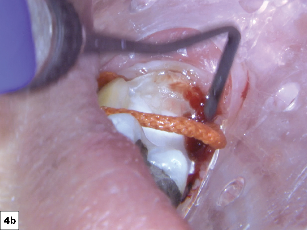 approach every intraoral scan with the understanding that a margin must be clearly identified in order to be restored