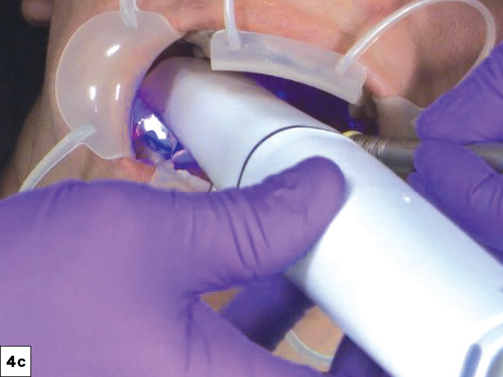 approach every intraoral scan with the understanding that a margin must be clearly identified in order to be restored