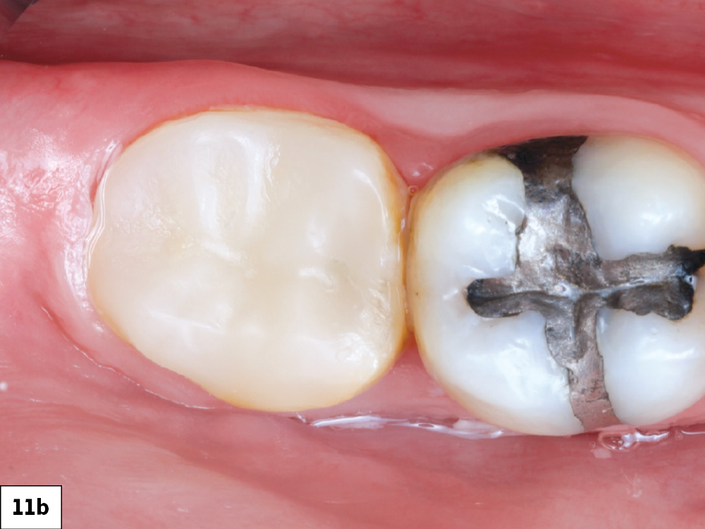 The patient presented with a large carious lesion on tooth #31. Due to the depth of the lesion and proximity to the pulp, the patient was informed that endodontic therapy and a full-coverage crown may be needed in the future, but at this juncture we could