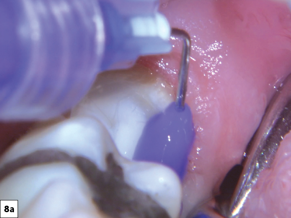 For the tooth preparation I used acid-etch on both enamel and dentin, followed by Gluma® (Kulzer North America; South Bend, Ind.) for desensitization and disinfection
