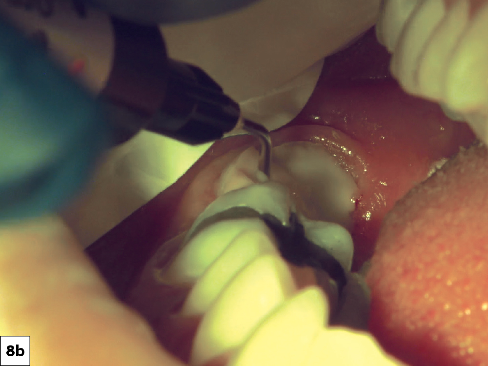 For the tooth preparation I used acid-etch on both enamel and dentin, followed by Gluma® (Kulzer North America; South Bend, Ind.) for desensitization and disinfection. I then scrubbed Scotchbond™ Universal (Solventum; St. Paul, Minn.) for 20 seconds and a