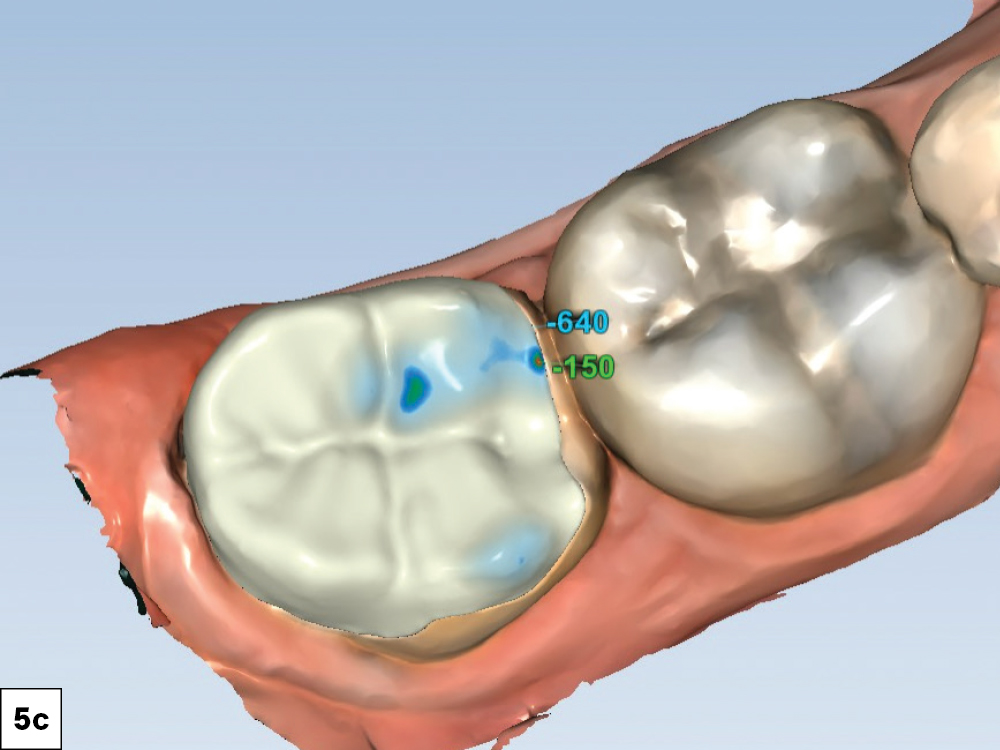 I selected the InlayAI feature to generate an initial design that closely matched the patient’s anatomy and added slight customization to the design
