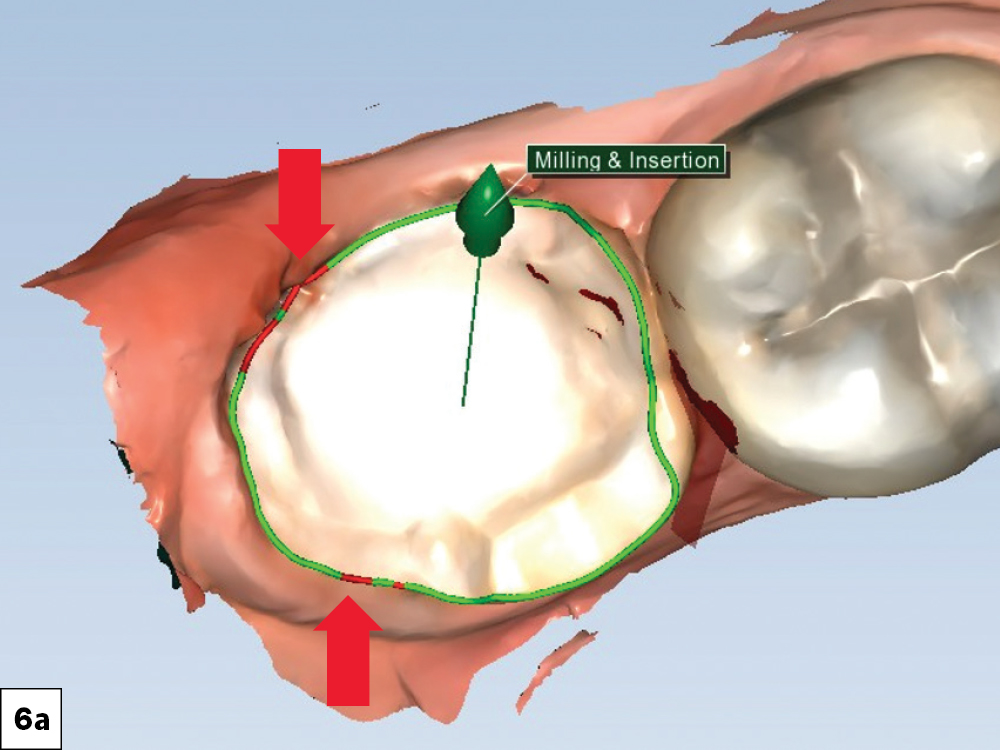 When checking the milling and insertion feature of the software, the areas marked by red arrows indicated unmillable areas at the margin