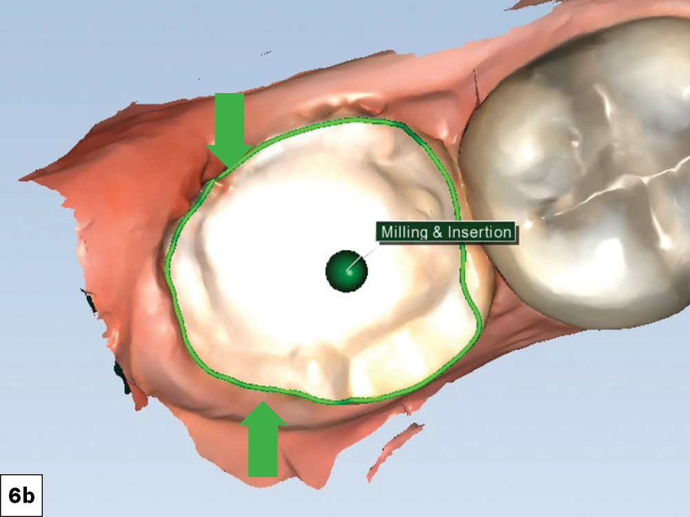 When checking the milling and insertion feature of the software, the areas marked by red arrows indicated unmillable areas at the margin
