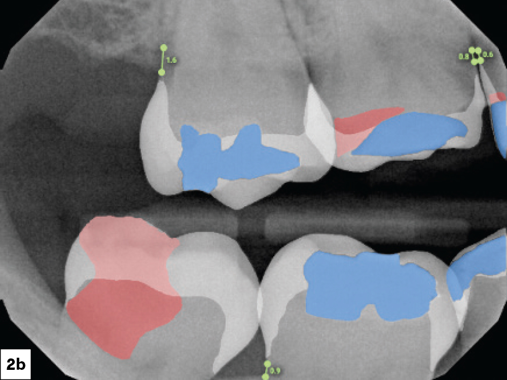 shows caries developing beneath the previous restoration and its significant progression over that period
