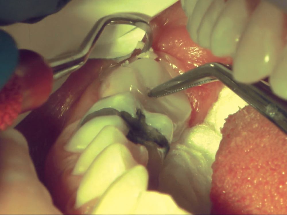 While my assistant applied pressure on the occlusal of the restoration, I spot-cured it. I then removed the gross excess cement and cleaned the interproximal using knotted floss and a QwikStrip™ (Creative Dental Concepts LLC; Birmingham, Mich.) to break c