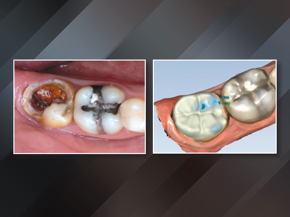 A Conservative Approach to Advanced Caries