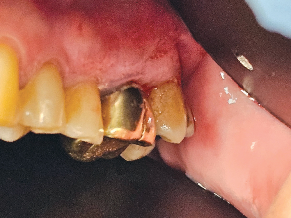Restoration of teeth #13–15 using BruxZir® NOW Milling Blocks, shade A4. Prior to delivery, the case involved a fractured lingual cusp on #13, recurrent decay on #14 and #15, removal of a previous gold crown on #14, endodontic treatment, and post-and-buil