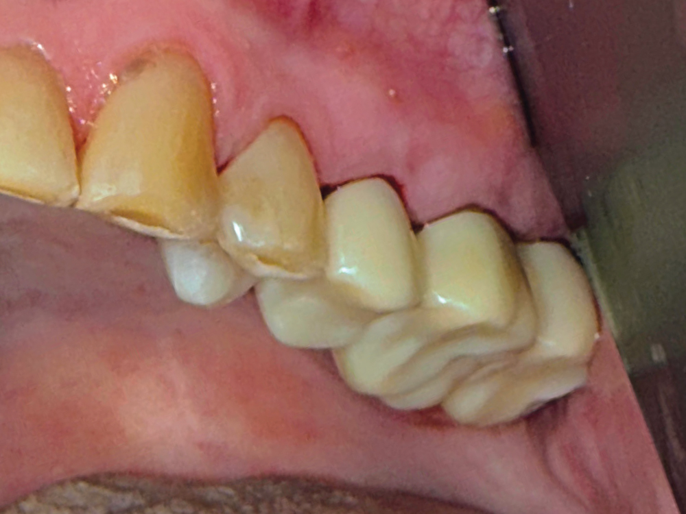 Restoration of teeth #13–15 using BruxZir® NOW Milling Blocks, shade A4. Prior to delivery, the case involved a fractured lingual cusp on #13, recurrent decay on #14 and #15, removal of a previous gold crown on #14, endodontic treatment, and post-and-buil