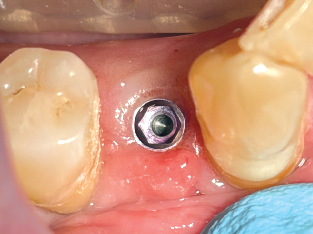 With BruxZir NOW SRC Milling Blocks, Dr. Jelani Winslow delivers screwretained implant restorations with the precision, esthetics and efficiency needed for a streamlined same-day workflow.