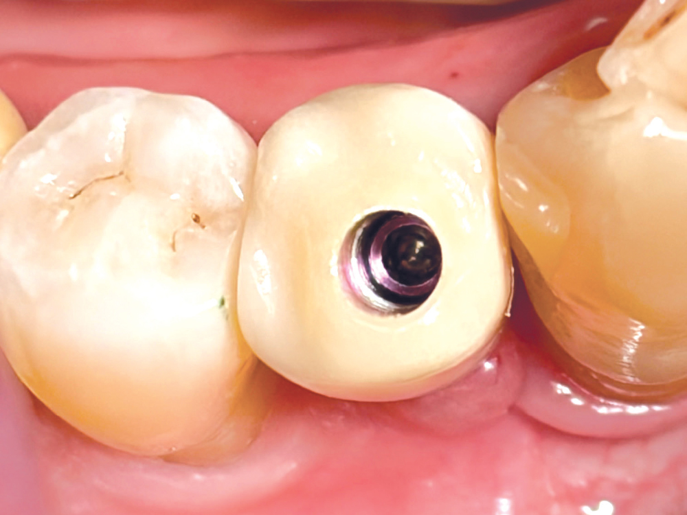 With BruxZir NOW SRC Milling Blocks, Dr. Jelani Winslow delivers screwretained implant restorations with the precision, esthetics and efficiency needed for a streamlined same-day workflow.