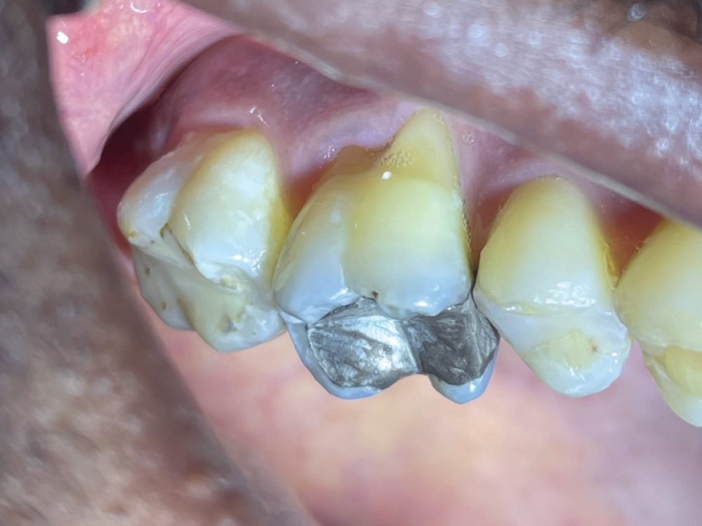 Conservative rehabilitation of a supraerupted #3 with a failing amalgam using CAMouflage NOW, relieving sensitivity and restoring function with a new lower DuraFlex™ partial (Myerson, Chicago, Ill.).